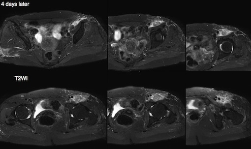 Figure 3 for case Neuritis Ossificans